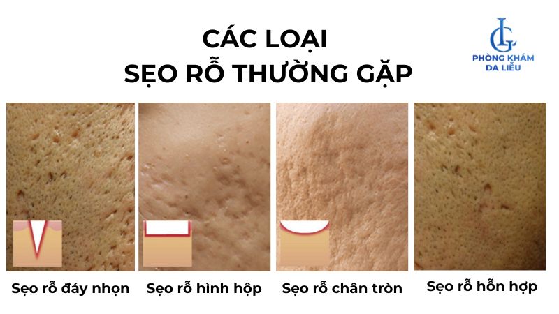 Loại sẹo rỗ