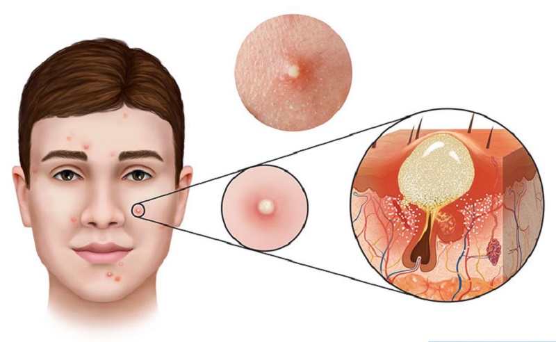 Trị mụn bọc ở mũi sau 1 đêm