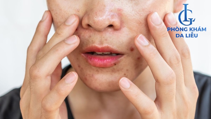 nóng người nổi mụn