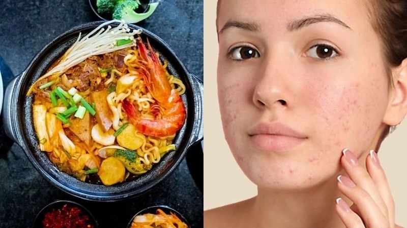 Ăn mì cay bị nổi mụn