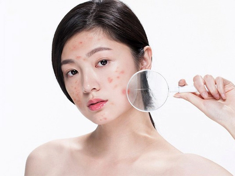 Bị mụn có nên ăn thịt bò không