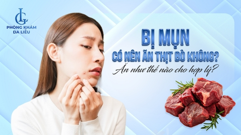 bị mụn có nên ăn thịt bò không