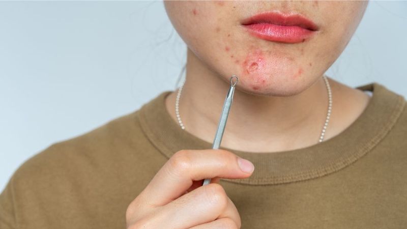 Cách nặn mụn bọc bị chai cứng tại nhà