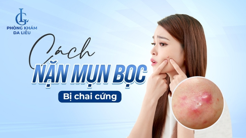 cách nặn mụn bọc bị chai cứng