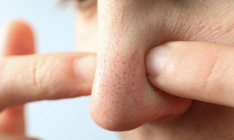 cách nặn mụn đầu đen tại nhà
