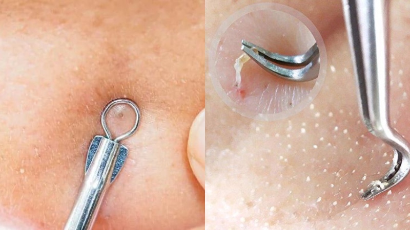 Nặn mụn đầu đen tại nhà