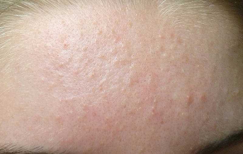 Mụn ẩn trên trán