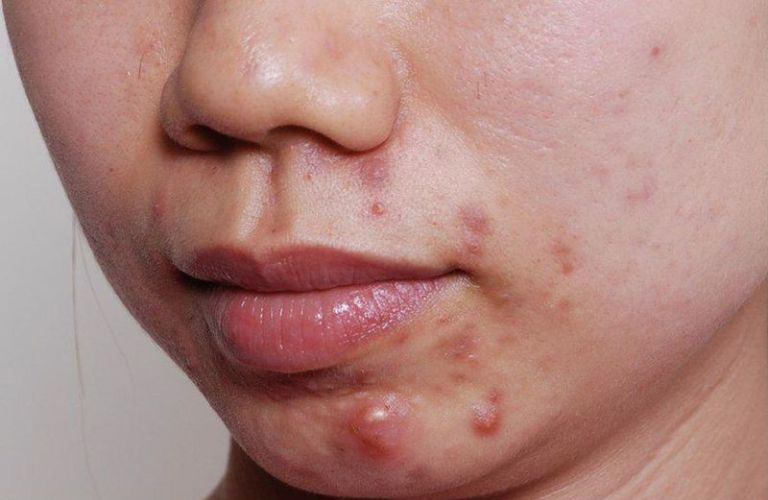 Mụn bọc có mủ