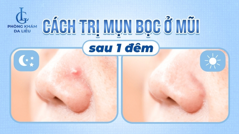 cách trị mụn bọc ở mũi