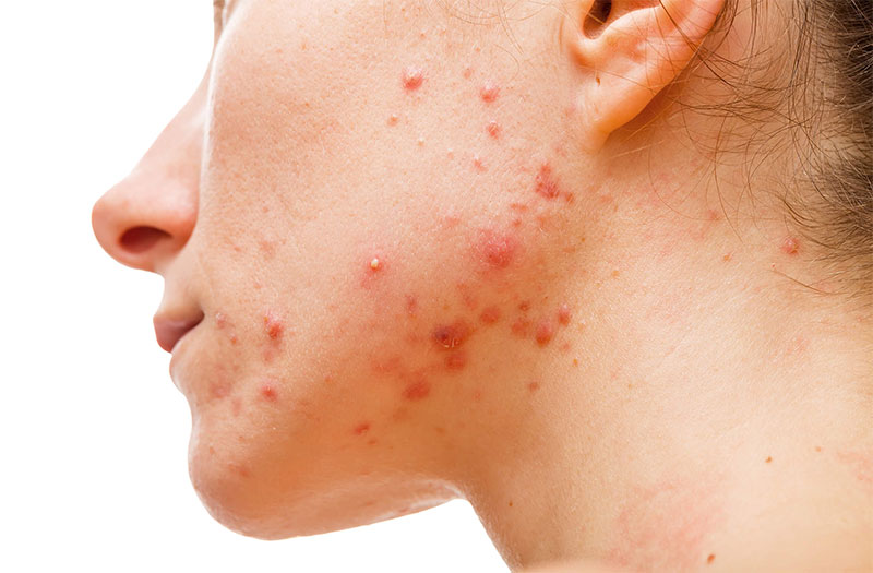 Cách trị mụn nội tiết dứt điểm