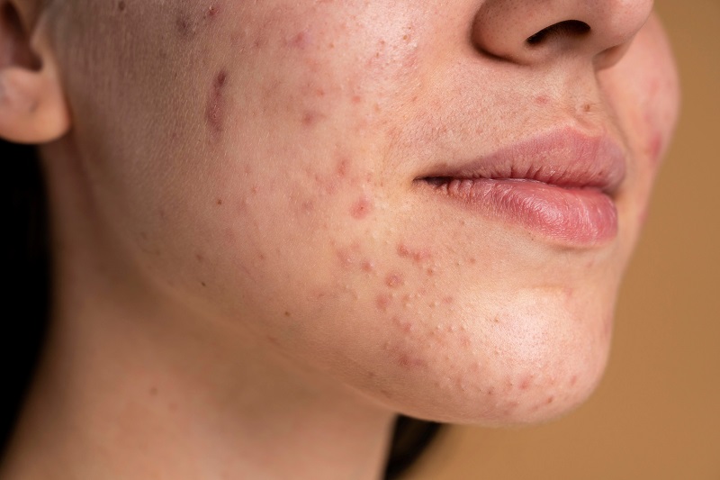 Cách trị mụn nội tiết dứt điểm