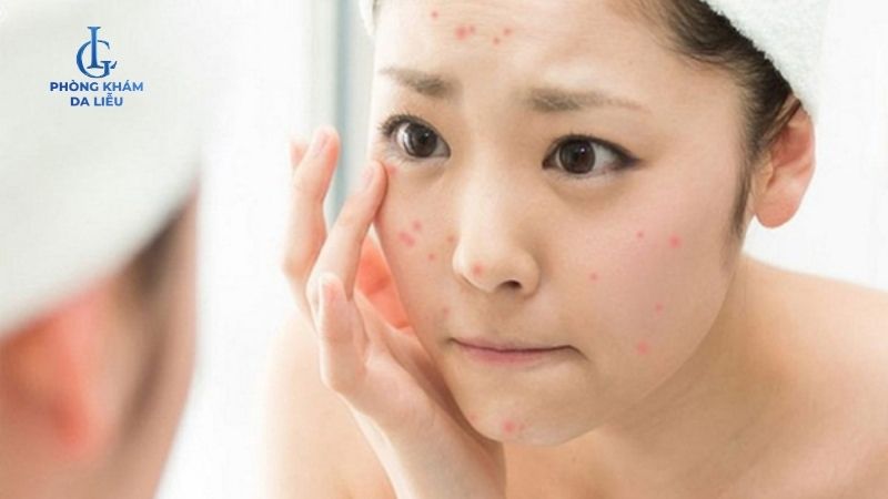Có nên peel da sau khi nặn mụn