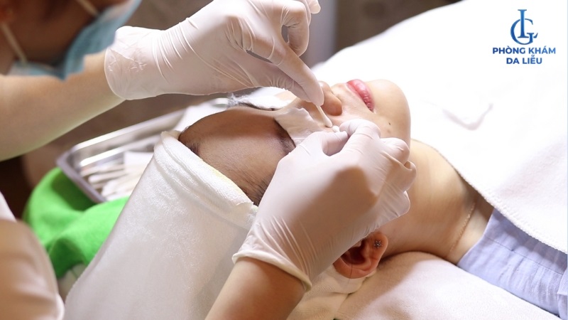 liệu trình nặn mụn