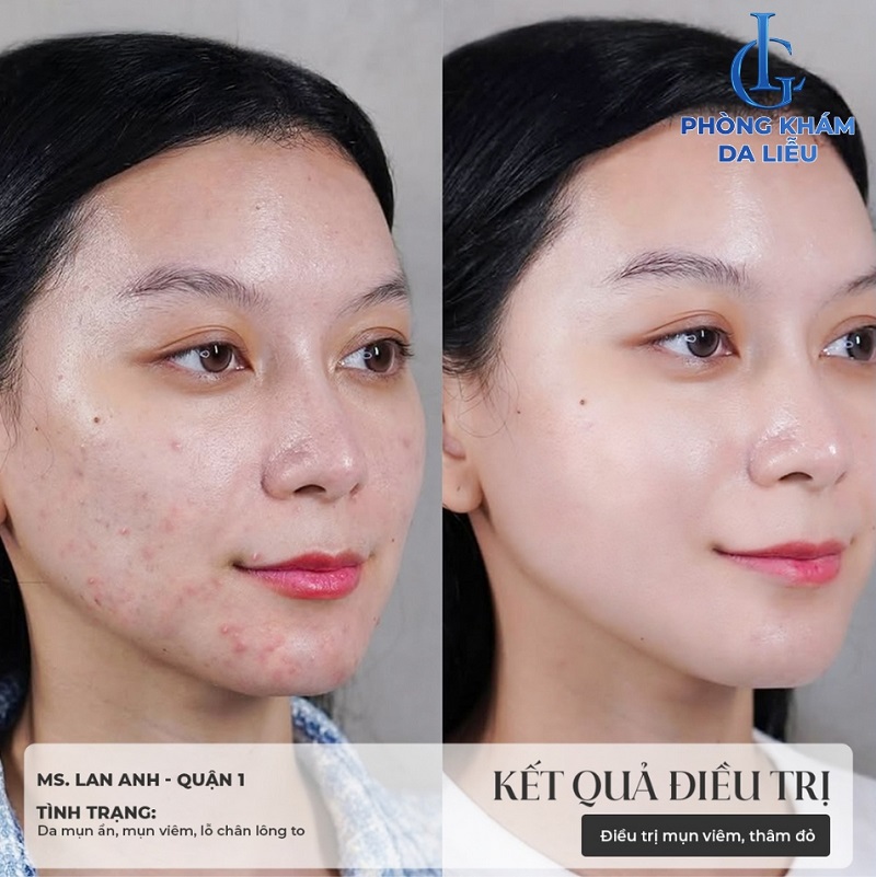 hình trước và sau khi áp dụng liệu trình trị mụn