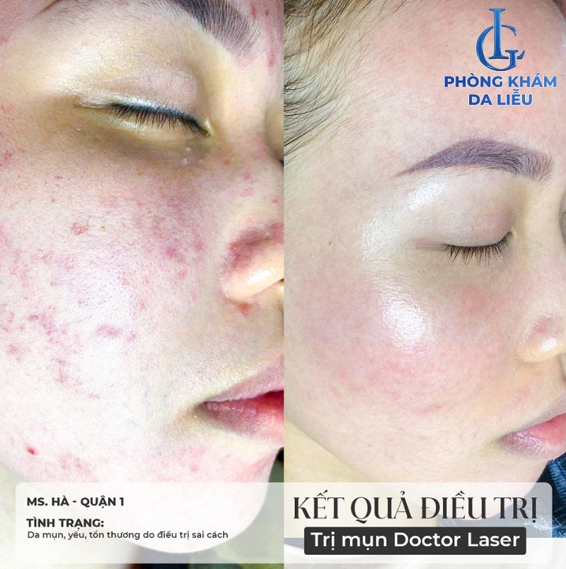 hình trước và sau khi áp dụng liệu trình trị mụn mặt