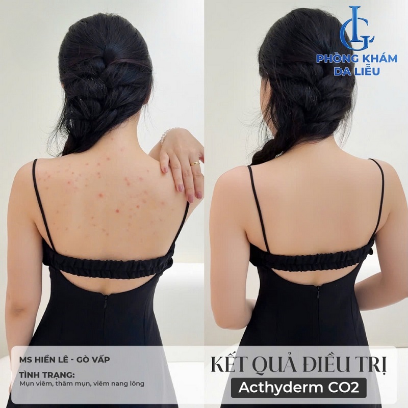 hình trước và sau khi áp dụng liệu trình trị mụn lưng