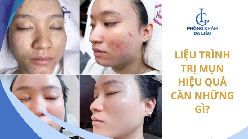 liệu trình điều trị mụn