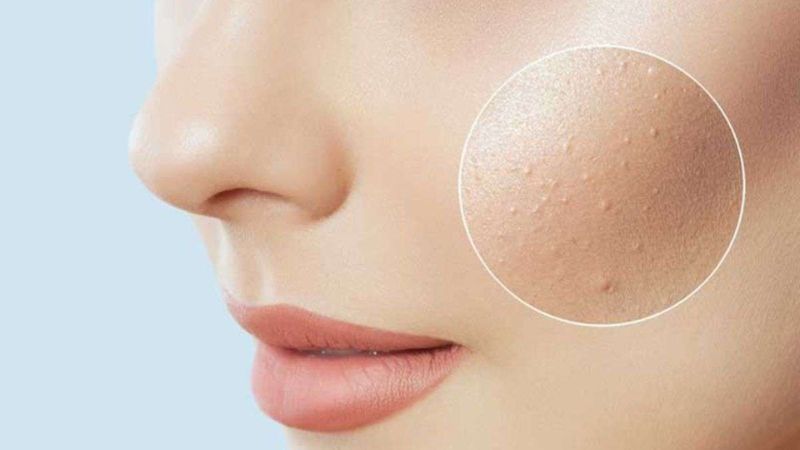 Da sần sùi vì mụn ẩn