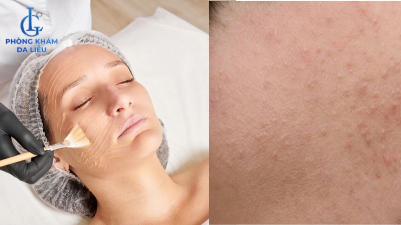 Peel da có trị mụn ẩn không