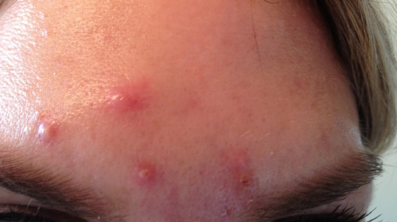 Mụn bọc không đầu