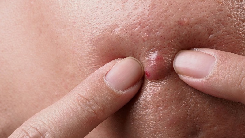 cách nặn mụn bọc không đầu