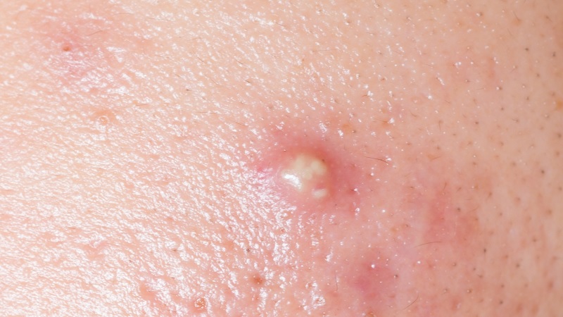 Các bước xử lý mụn bọc có mủ đúng cách
