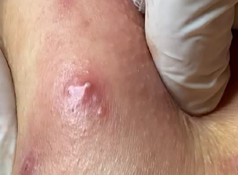 Mụn bọc mủ là sao?