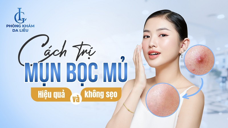 mụn bọc có mủ phải làm sao