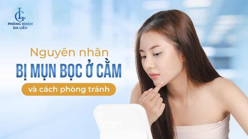 mụn bọc ở cằm