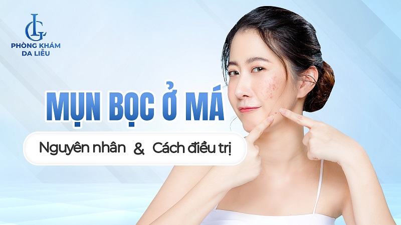 mụn bọc ở má có nên nặn không?