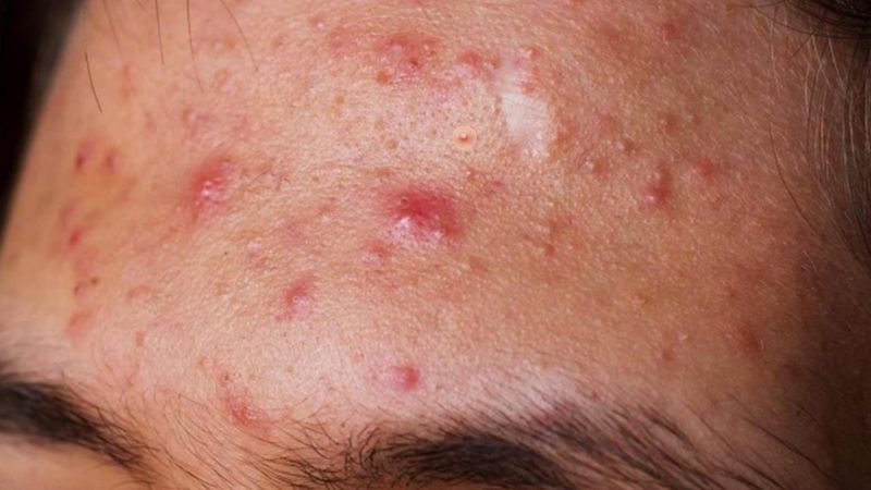 Cacsg trị mụn bọc ở trán sưng to