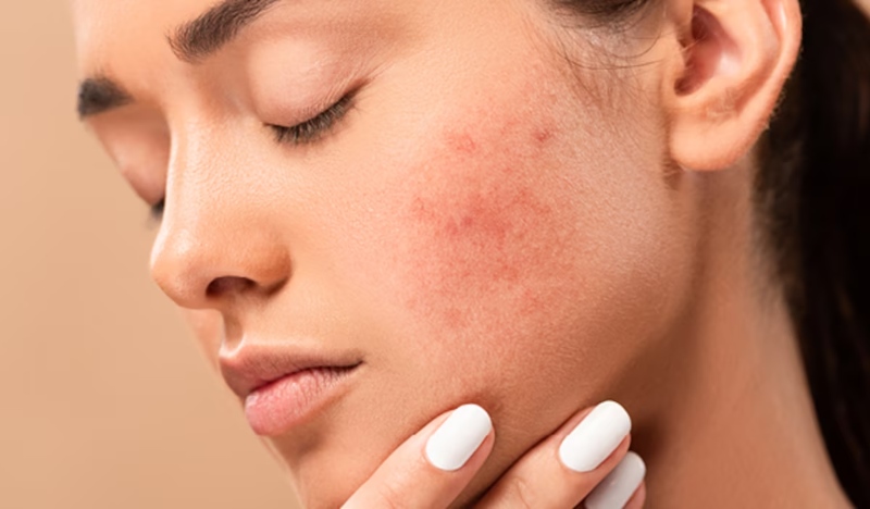 có nên nặn mụn đầu đen không