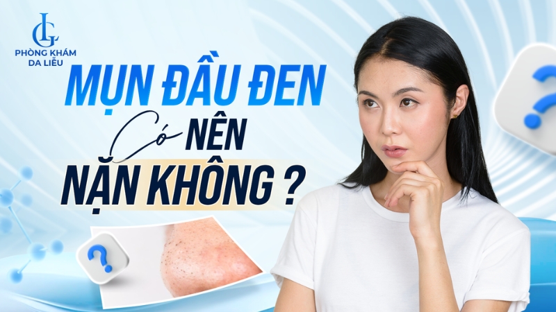 Mụn đầu đen có nên nặn không?