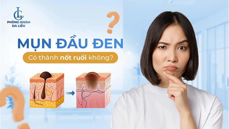 Mụn đầu đen có thành nốt ruồi không?