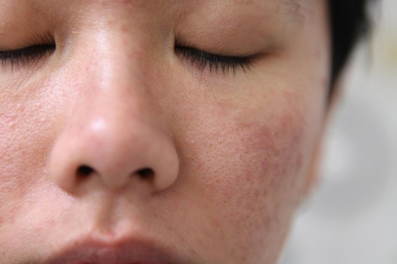 Mụn đầu đen để lâu có sao không