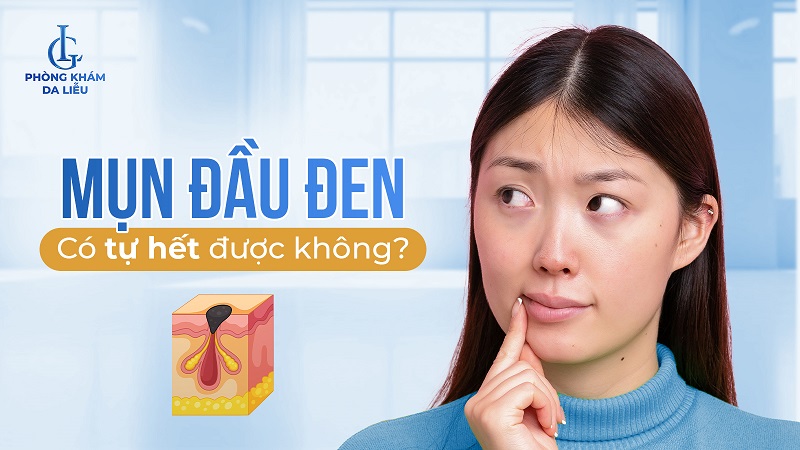 Mụn đầu đen có tự hết được không?
