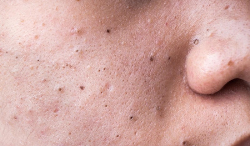 Nguyên nhân gây mụn đầu đen ở má