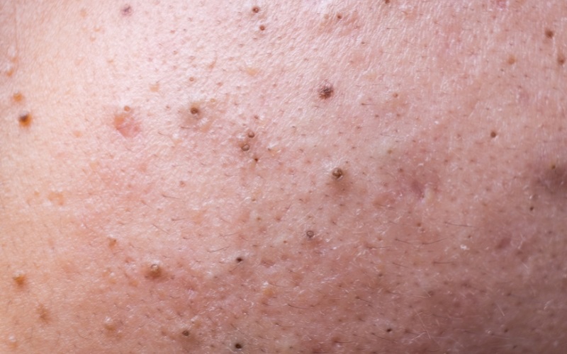 mụn đầu đen ở má