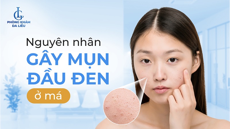 Mụn đầu đen ở má