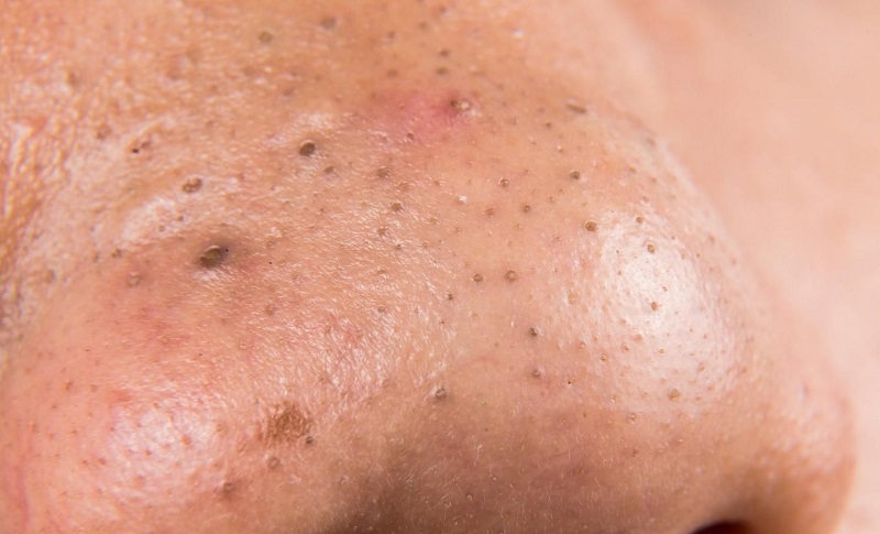 Mụn đầu đen để lâu có sao không?