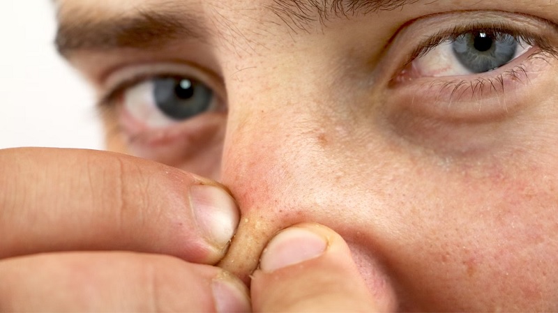 Mụn đầu đen có nên nặn không?