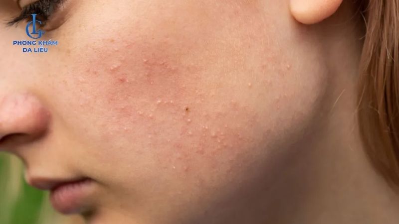 Peel da bị nổi mụn nước