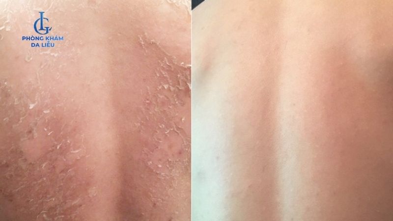 Peel da mụn lưng