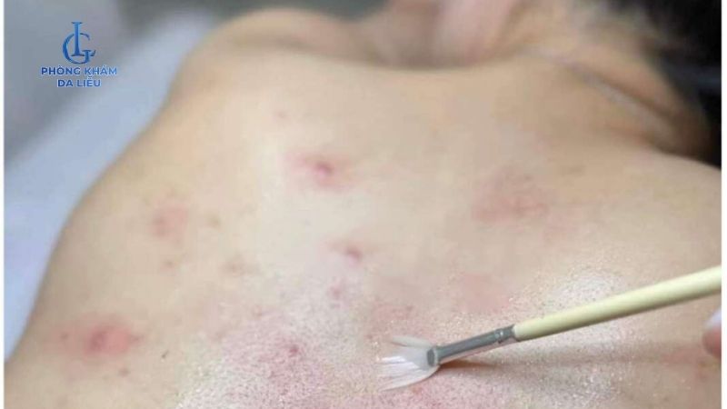 Peel da mụn lưng