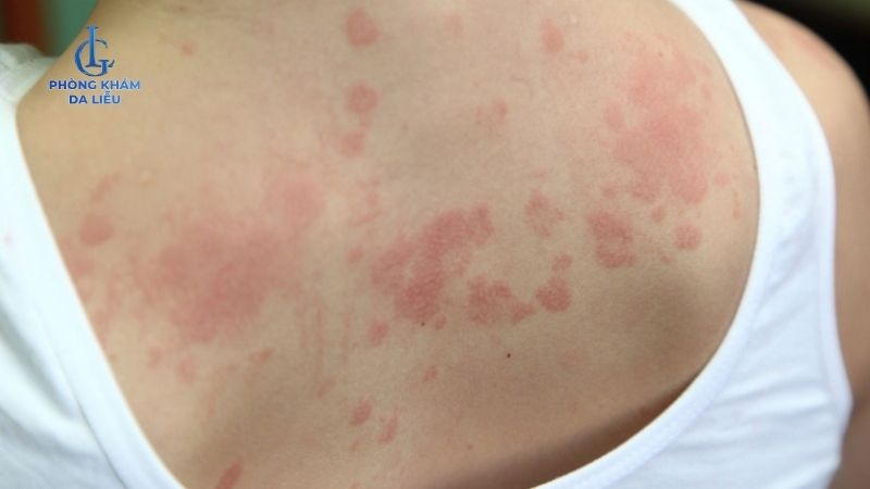 Peel da mụn lưng