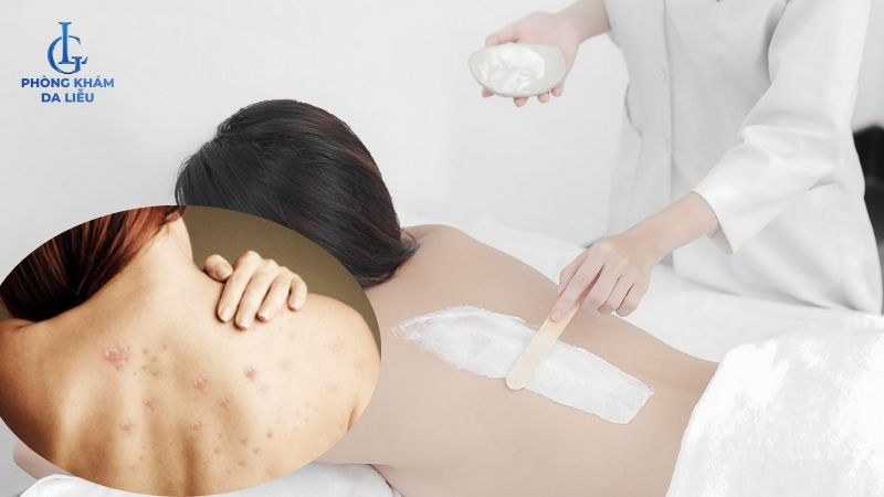 peel da trị mụn lưng