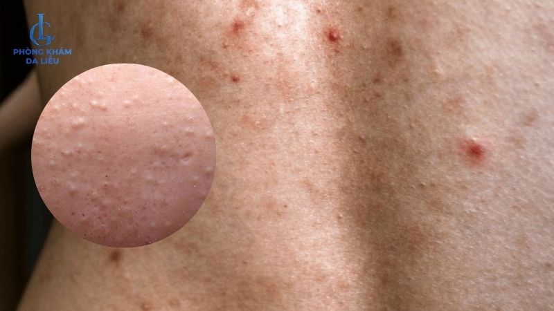 mụn ẩn ở lưng 