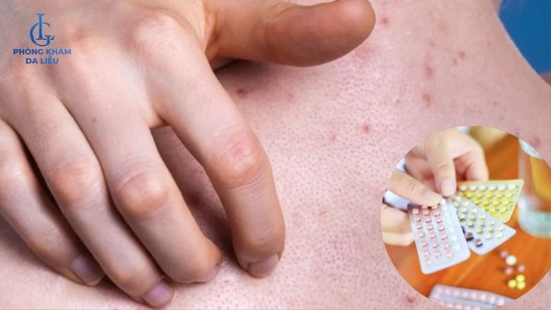 nguyên nhân gây mụn lưng