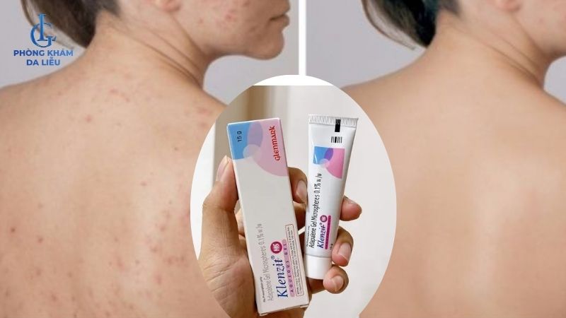 bôi thuốc trị mụn ẩn lưng