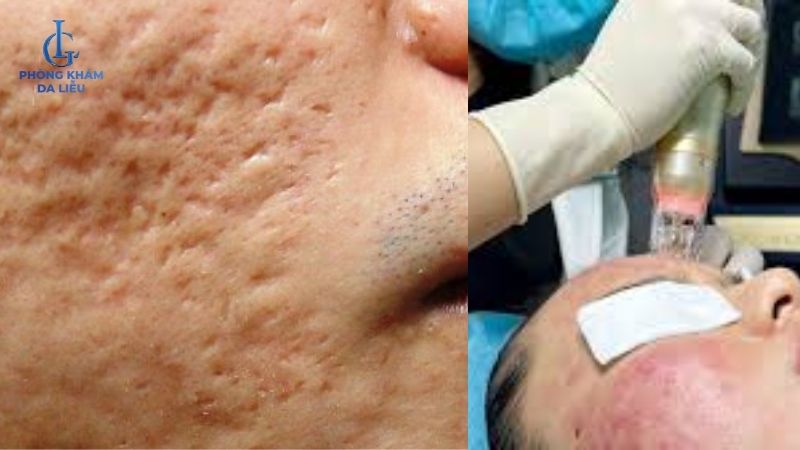 Vi điểm trị sẹo rỗ